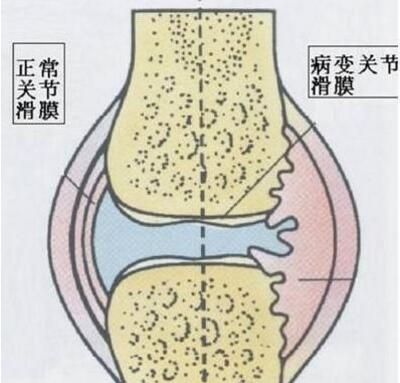化脓性关节炎任其发展或致其关节丧失功能,看这里有备无患